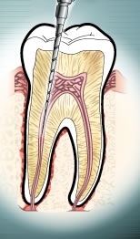 Click image for larger version

Name:	endodoncia[1].JPG
Views:	242
Size:	31.3 KB
ID:	245817