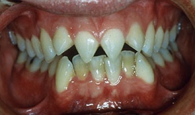 Click image for larger version

Name:	6 tooth filing.jpg
Views:	1236
Size:	36.0 KB
ID:	246130