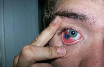 Click image for larger version

Name:	3 corneal tattooing.jpg
Views:	4327
Size:	38.1 KB
ID:	246132